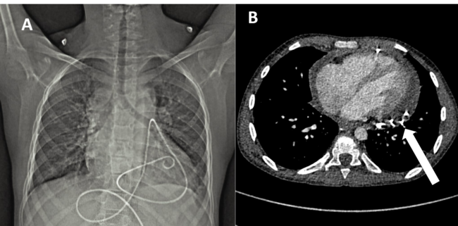 Caught in the Web: Alteplase-Assisted Rescue of an Entrapped